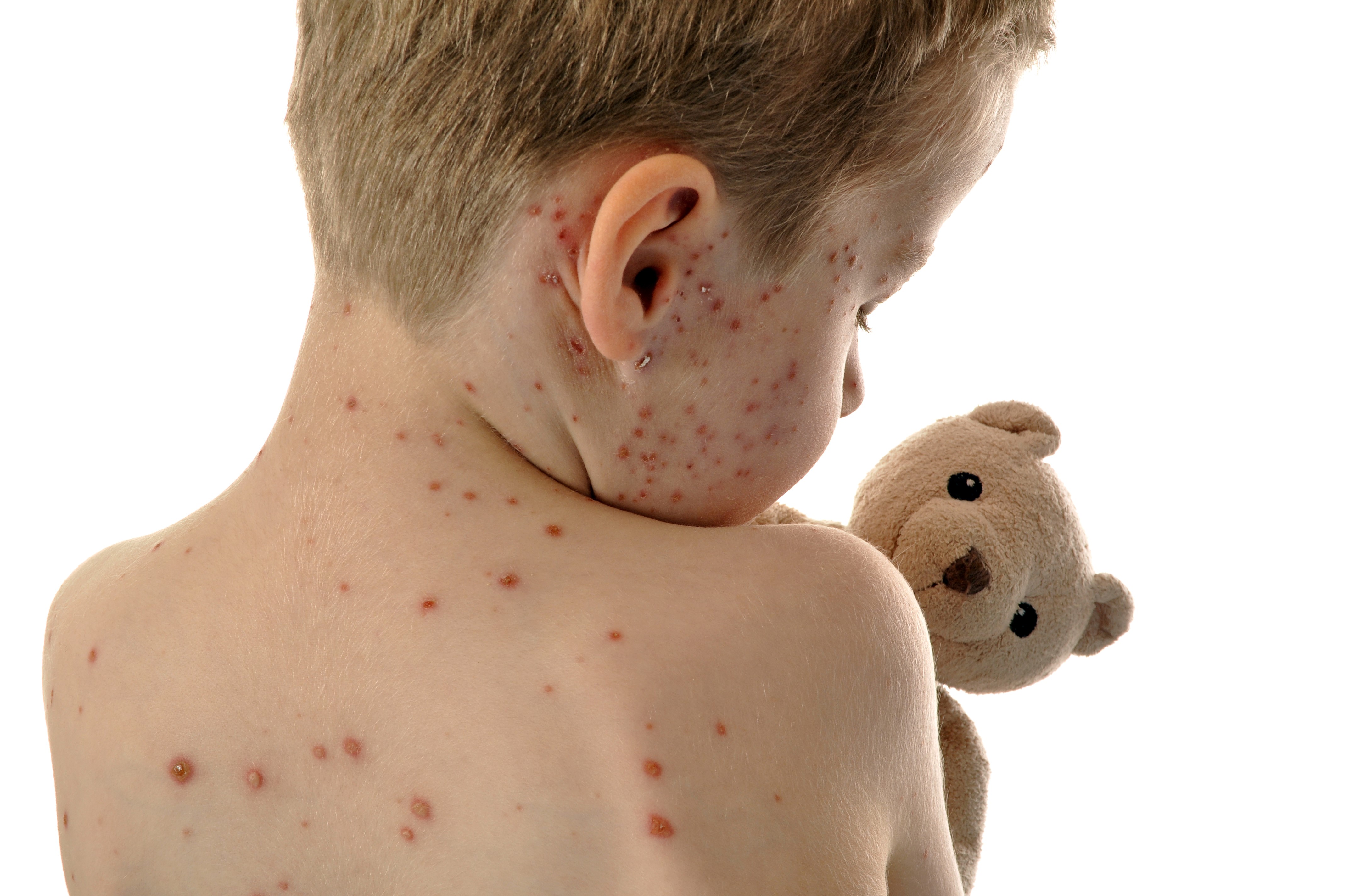 WHO Warns Of Rising Spread Of Measles