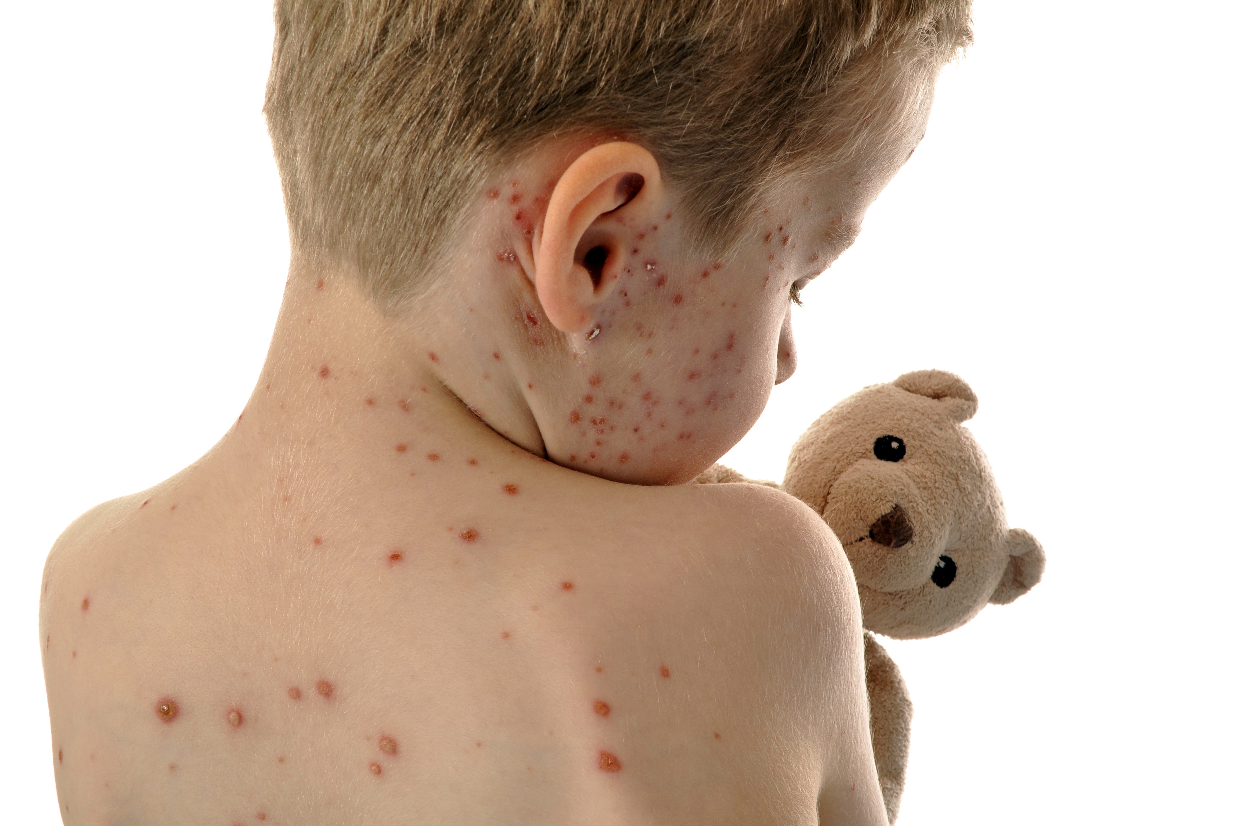 Measles Pediatric Associates of Charlottesville