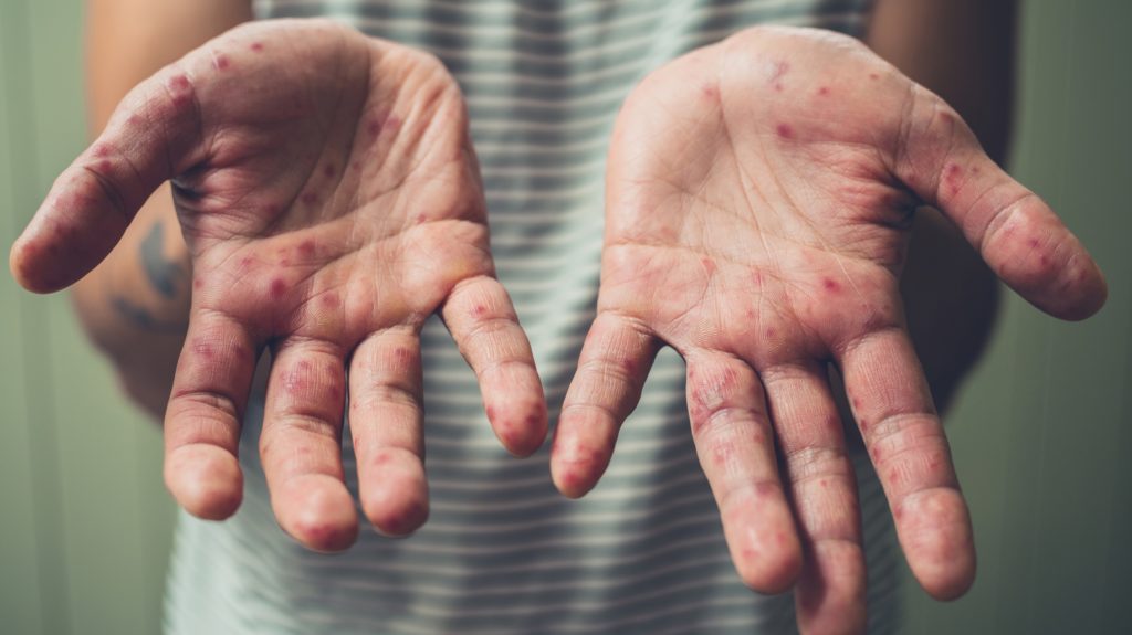 Hand Foot And Mouth Disease HFMD Pediatric Associates Of 